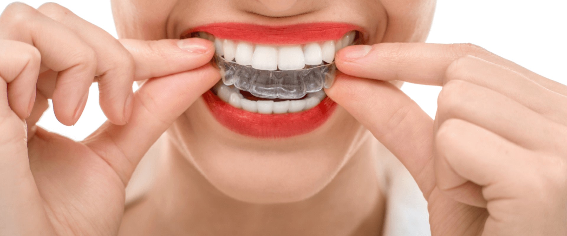 How Long Does It Take For Invisalign To Work