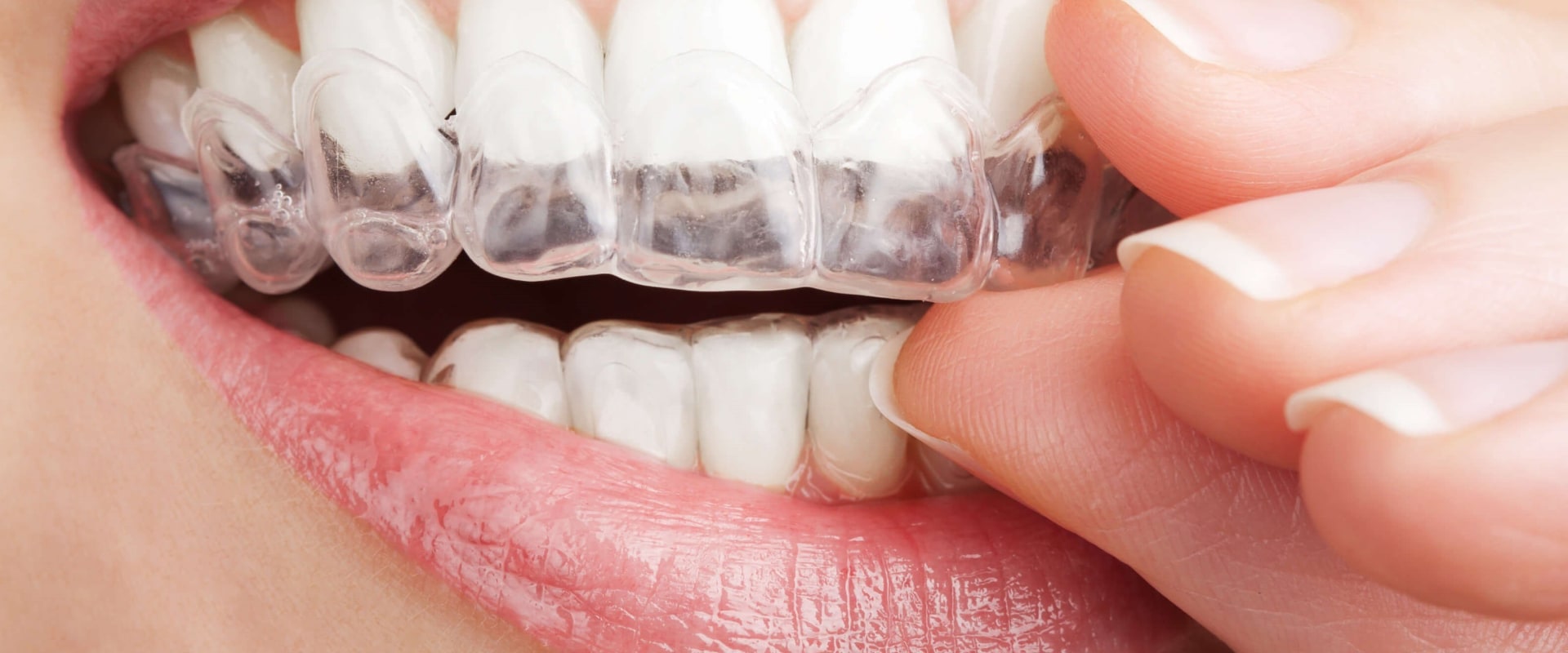 Invisalign vs Traditional Braces: Which is Better?